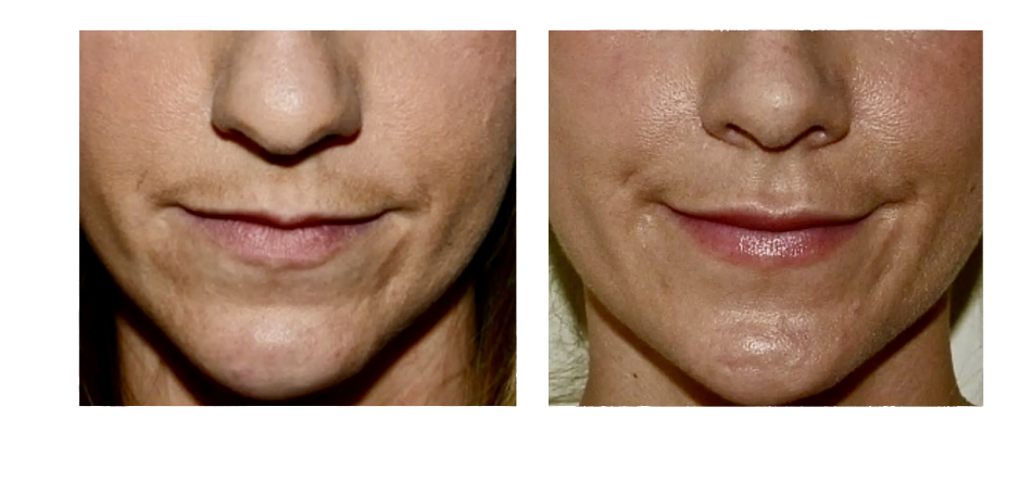 byohyalux-before-after@1x