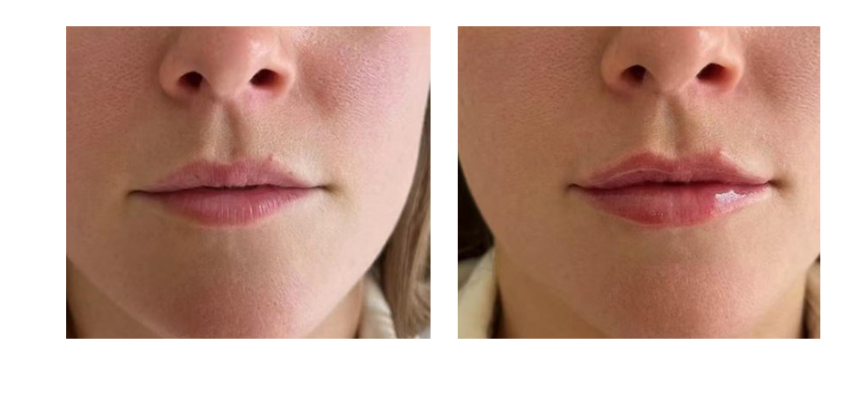 biohyalux before and after6@1x